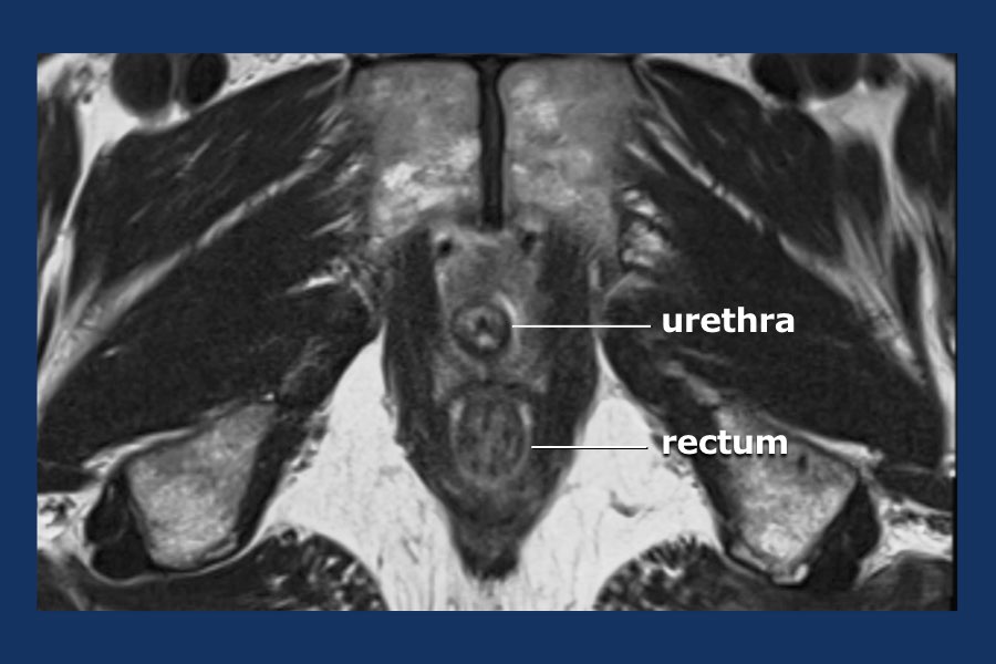 The Radiology Assistant Prostate Cancer Pi Rads V2 4956