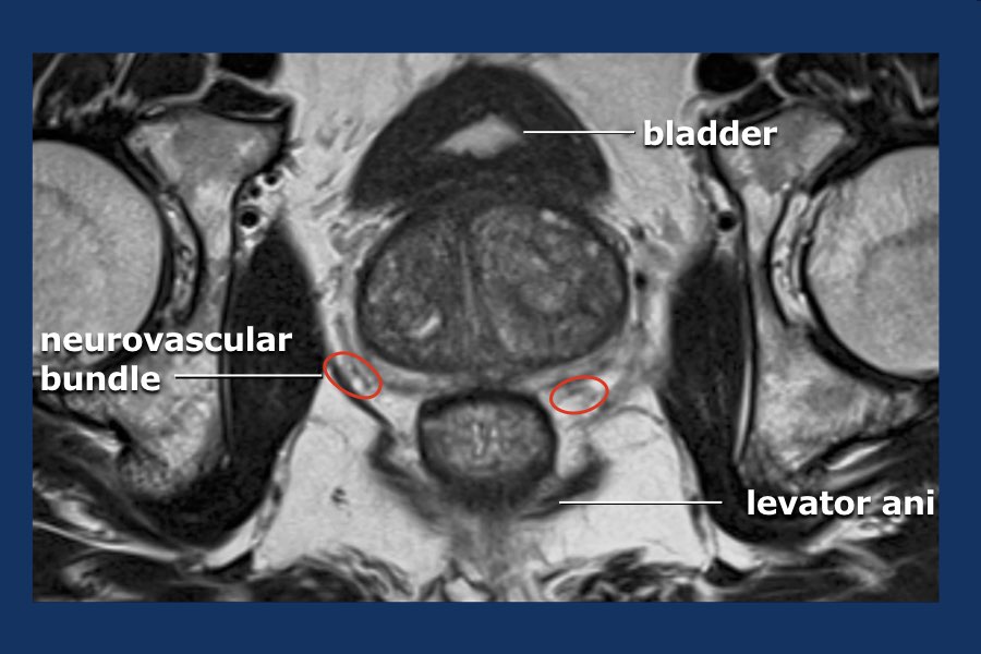 prostate mri neurovascular bundle Népi jogorvoslatok a prosztatitis kezelésből