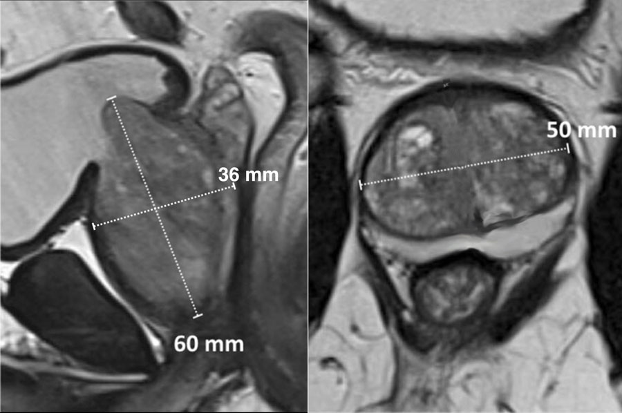 normal prostatic size radiology)