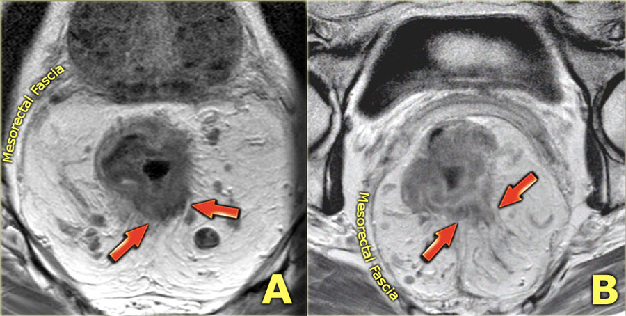 rectal cancer venous invasion mri)