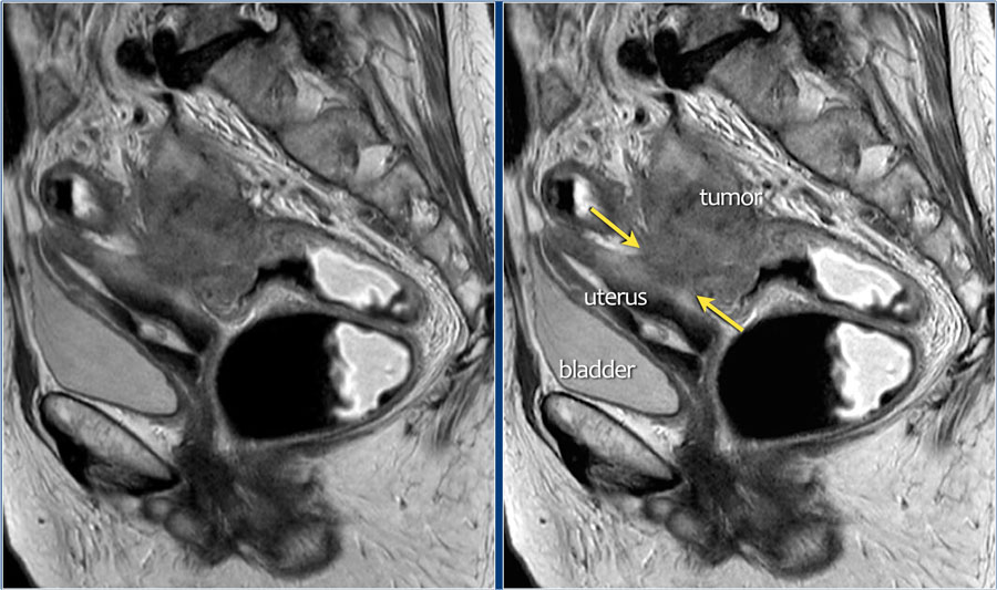 The Radiology Assistant : Rectal Cancer - MR Staging 2.0