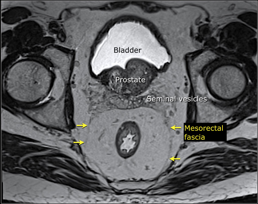 Rectal cancer on ct scan