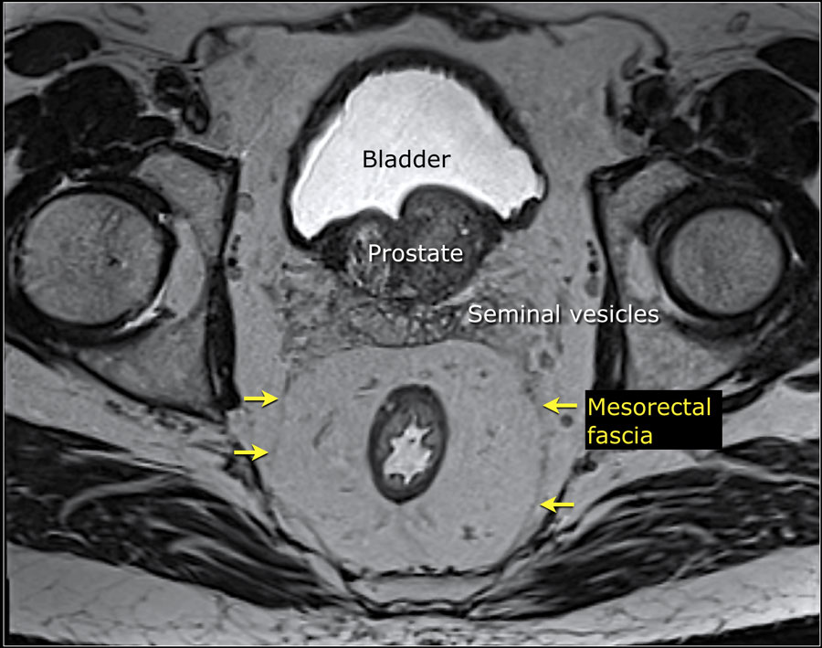 Rectal cancer venous invasion mri, Rectal cancer in mri