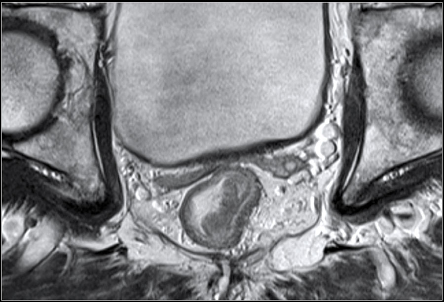 Параректальная клетчатка на кт. Мрт свища прямой. Нижнеампулярный отдел прямой кишки мрт. Мрт свища прямой. Параректальный свищ мрт.