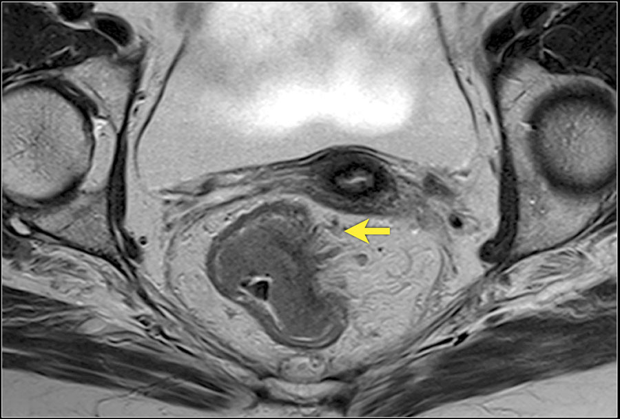 tratamentul diagnostic papilomas vulva cu condiloame