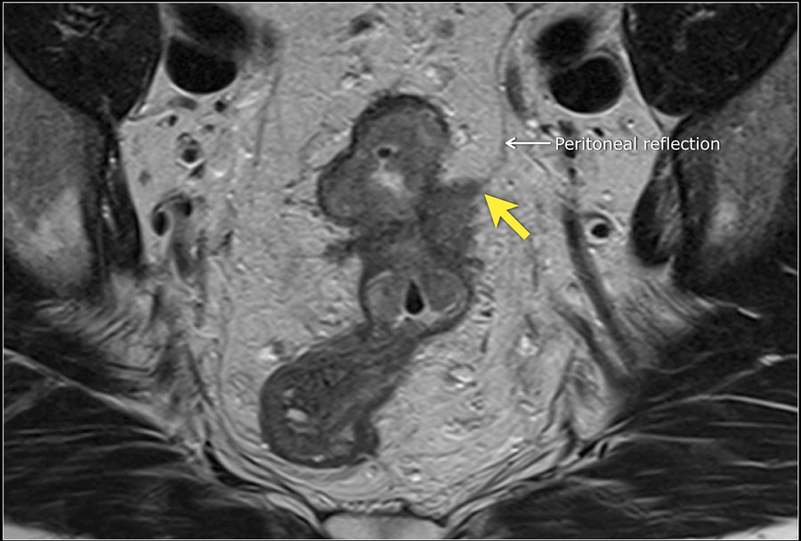 what do tumors on the lungs mean