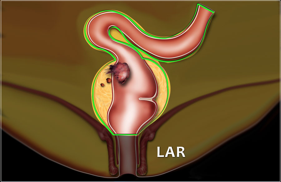 The Radiology Assistant : Rectal Cancer - MR staging 2.0