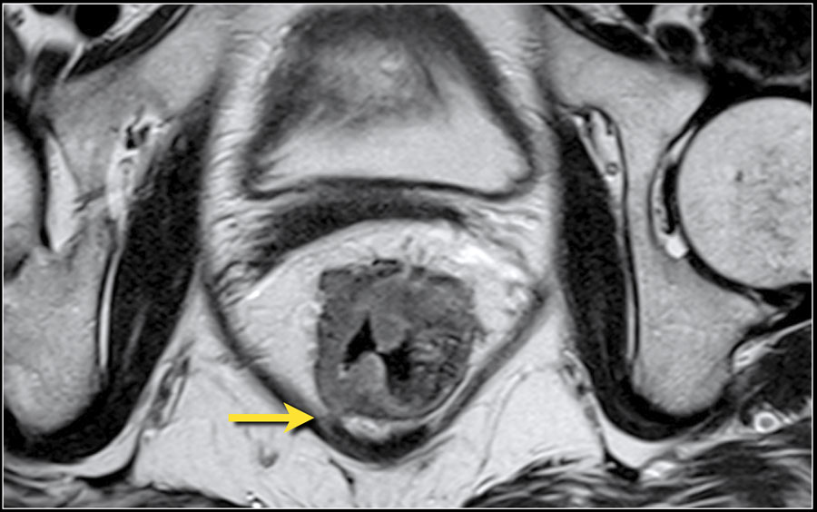 The Radiology Assistant : Rectal Cancer - MR Staging 2.0