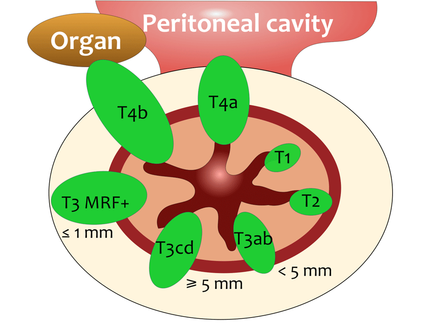 The Radiology Assistant Rectal Cancer Mr Staging 20 