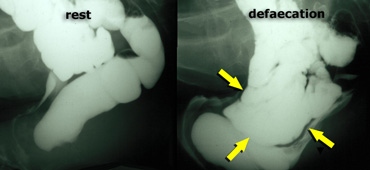 Normal findings at rest (left);  during defecation there is a rectocele, that is pushed downward by an enterocele .