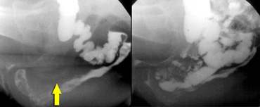 LEFT: Pathology is suspected because of a great distance between rectum and vagina. No oral contrast had been given. RIGHT: After ingestion of liquid barium contrast a large enterocele is seen.