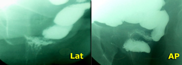 S-shaped rectum which simulates an intussuseption on the lateral view (same case as above).