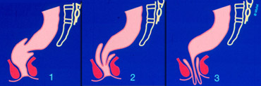 1 : Intra-rectal intussusception,  2 : Intra-anal intussusception,  3 : Extra-anal intussusception (rectal prolapse)