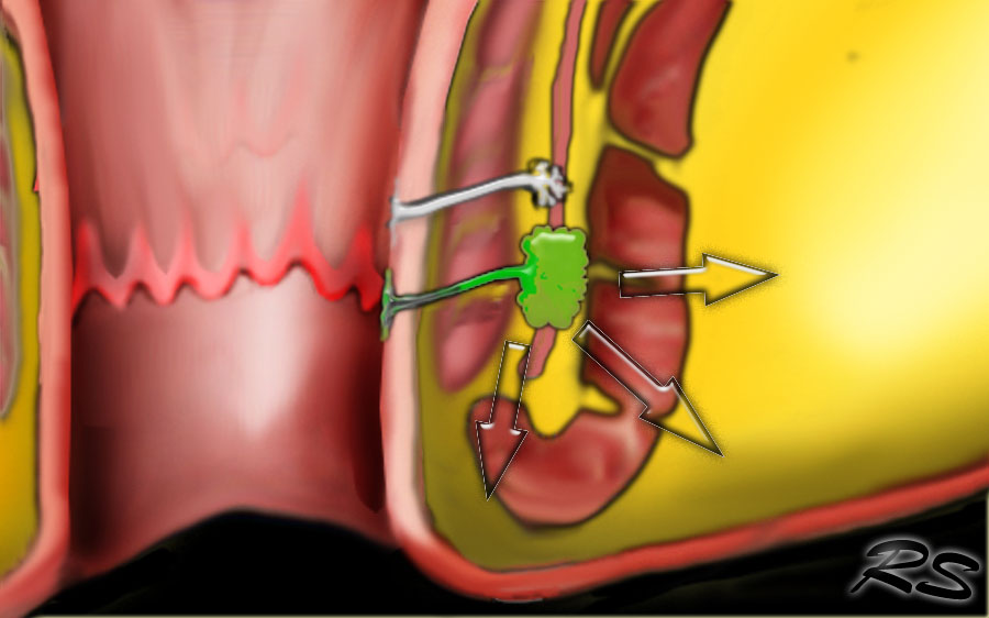 fistula a lábán visszeres