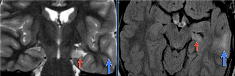 Dual pathology: MTS and focal cortical dysplasia