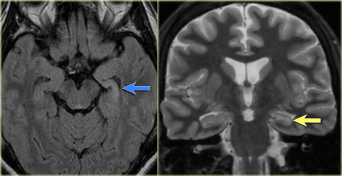 Left mesial temporal sclerosis. Subtle gliosis of left hippocampus (blue arrow) and atrophy (yellow arrow).
