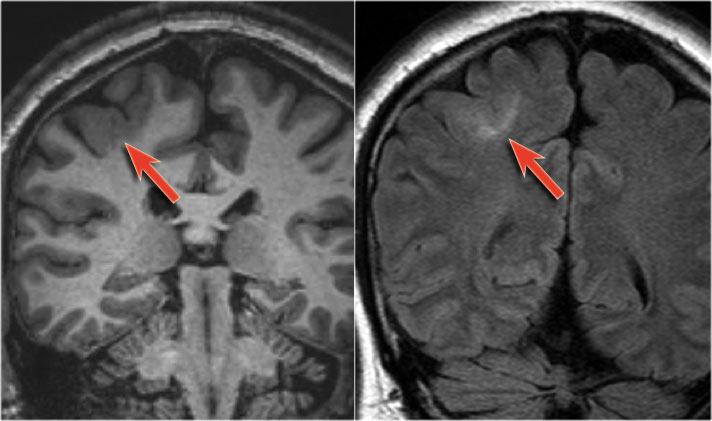 Focal cortical dysplasia - coronal T1WI and FLAIR