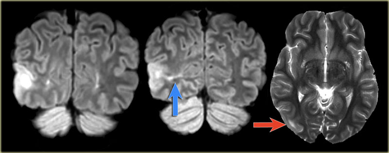 Focal cortical dysplasia in the right occipital lobe with transmantle sign