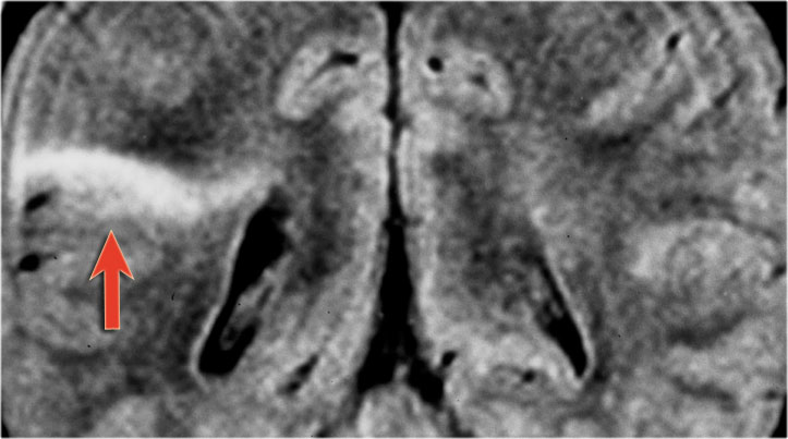 Focal cortical dysplasia  - Transmantle sign.