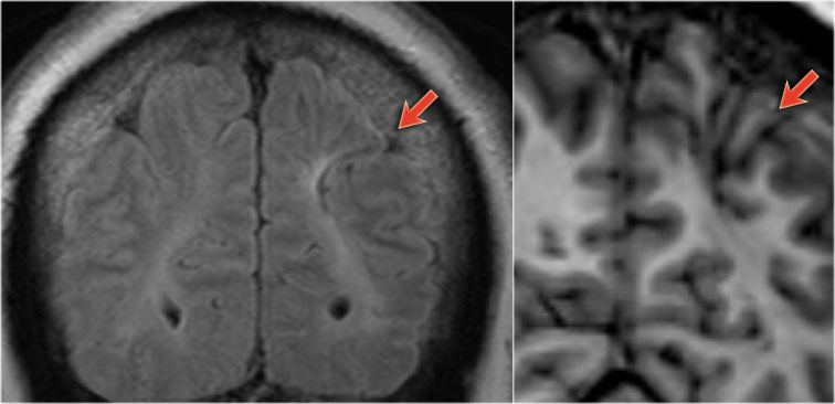 54-year-old patient with a history of perinatal asphyxia and longstanding refractory partial epilepsia. Left parietal scar in the parasagittal watershed area resulting in a shrunken cortex.