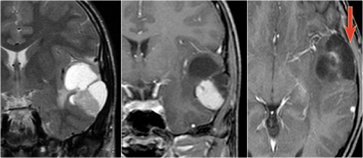 Pleomorphic xanthoastrocytoma on coronal T2WI and a coronal and axial CE-T1WI.Notice characteristic meningocerebral enhancement (arrow)