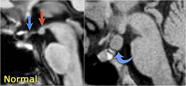 LEFT: Normal infundibular recess of the third ventricle (blue arrow) , mamillary bodies (red arrow)RIGHT: Tuber cinereum hamartoma (curved arrow)