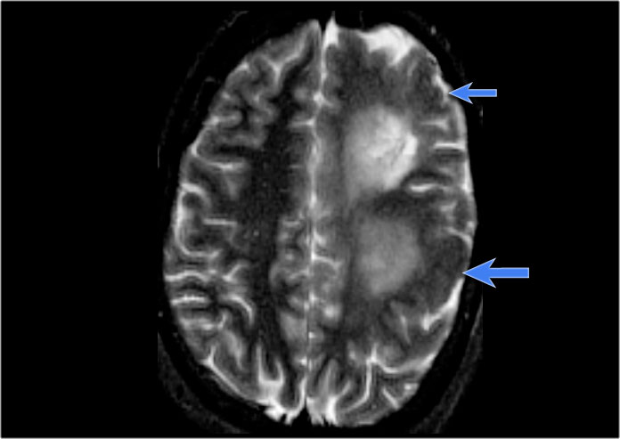 Left hemimegalencephaly with diffuse cortical dysplasia involving fronto-parietal regions (blue arrows) and diffuse white matter T2 hyperintensity