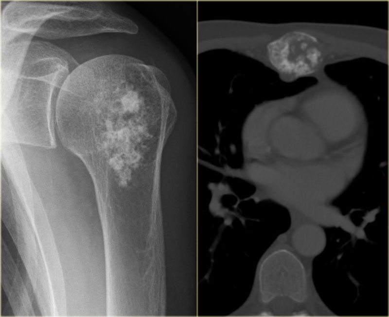 The Radiology Assistant : Bone - Sclerotic tumors and tumor-like lesions