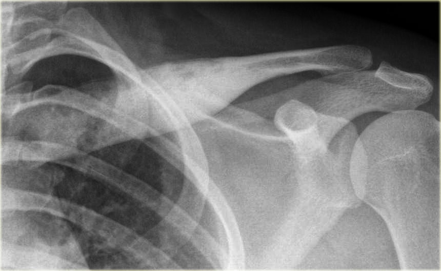 Eosinophilic granuloma as sclerotic lesion in the clavicle.