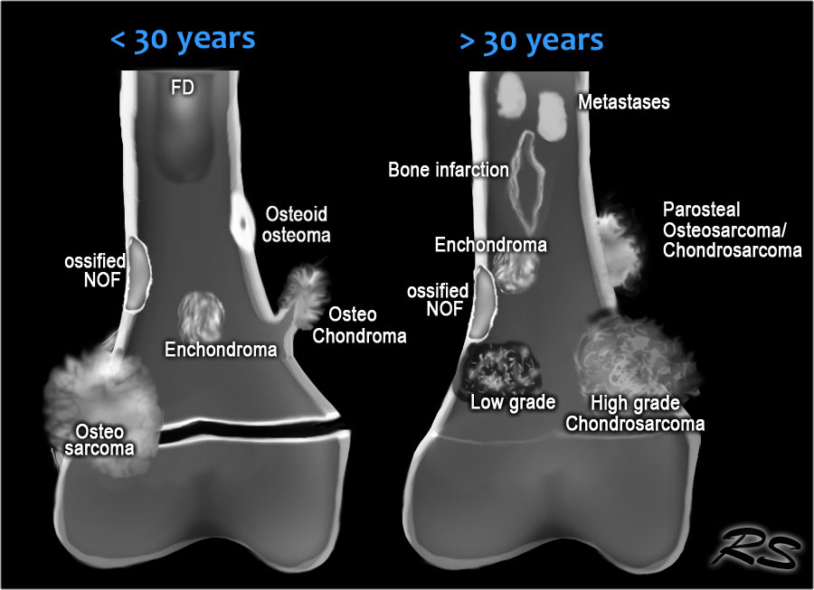 the-radiology-assistant-bone-sclerotic-tumors-and-tumor-like-lesions