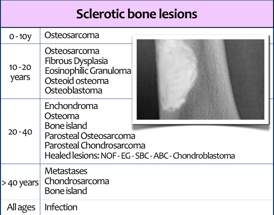 The Radiology Assistant : Sclerotic tumors