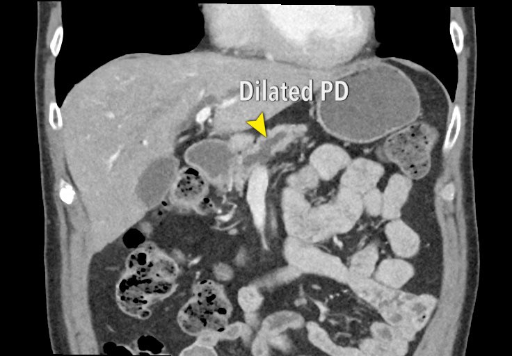 Pancreatic Imaging Mimics Part 1 Imaging Mimics Of 44 OFF