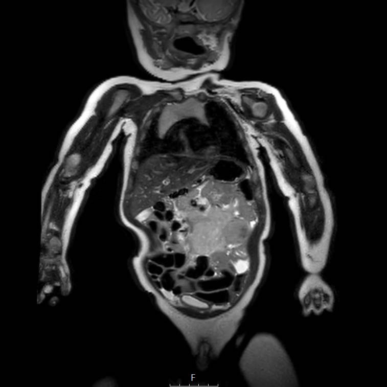 a) A 12-year-old boy presented with a large chest wall mass, later