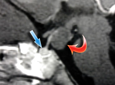 Hamartoma (red arrow) posterior to the enhancing pituitary gland and stalk.