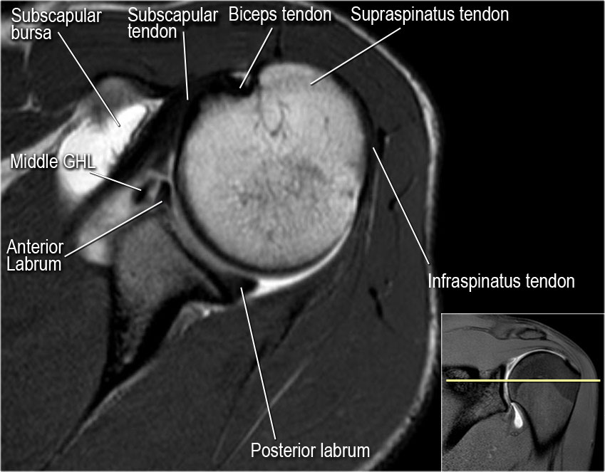 The Radiology Assistant : Shoulder MR - Anatomy