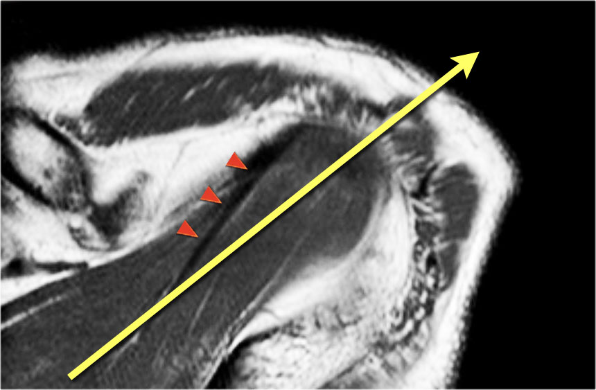how to read mri images for a torn rotator cuff