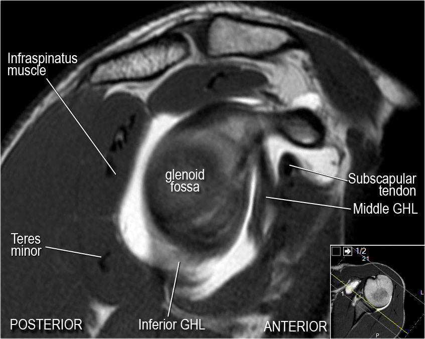 The Radiology Assistant : Shoulder MR - Anatomy