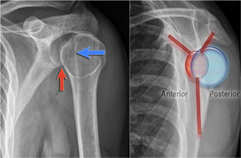 The Radiology Assistant : Shoulder MR - Instability