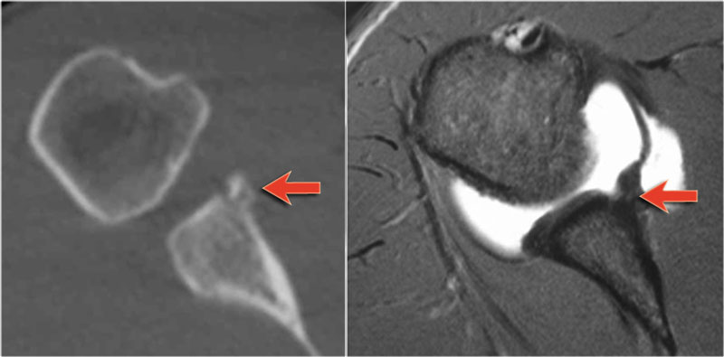 CT and MR-arthrography in a patient with an osseus Bankart (arrow)