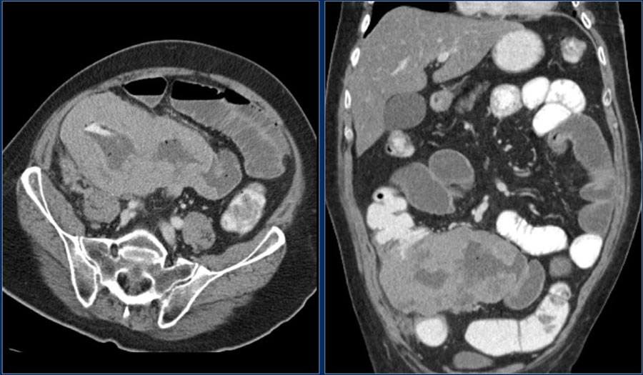 The Radiology Assistant Small Bowel Tumors