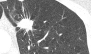 Corona radiata sign in a malignant lesion with spiculation at the margin.