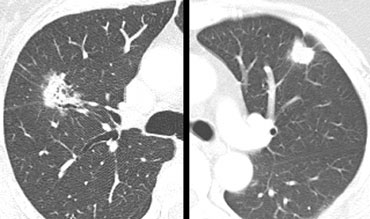 calcified lung adenocarcinoma ct