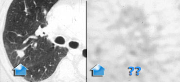 False negative PET in a patient with adenocarcinoma. Activity is not sufficient for the diagnosis malignancy.