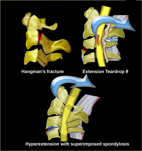 Hyperextension injuries