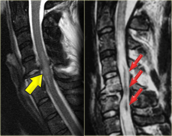 Non-hemorrhagic and hemorrhagic spinal cord injury