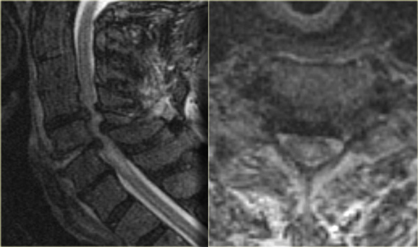 Central spinal cord injury in a patient with a hyperextension injury and preexisting spondylosis and stenosis.