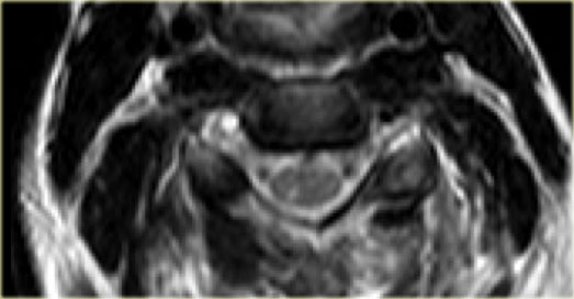 Vertebral artery thrombosis: no flow void in the right vertebral artery