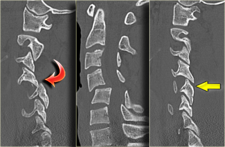 The Radiology Assistant : Cervical Injury