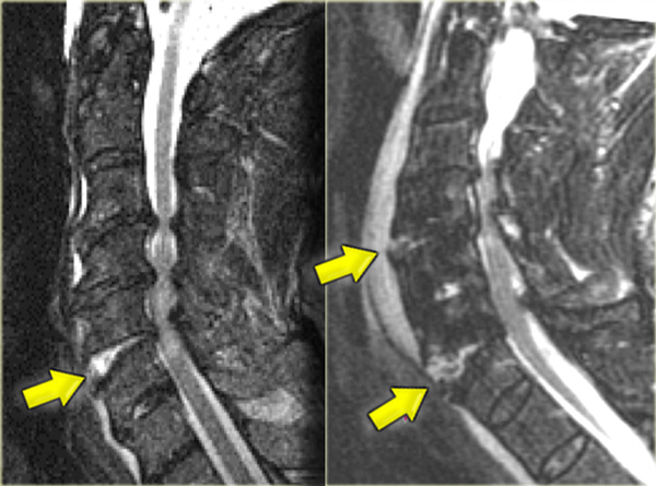 Hyperextension with superimposed spondylosis