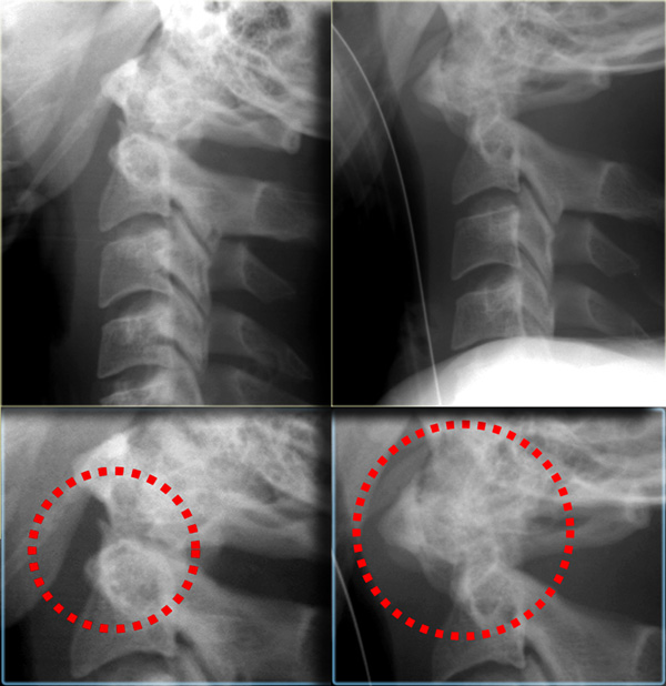 Odontoid and hangman fracture